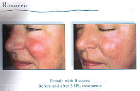 Chicago Laser Rosacea Treatment